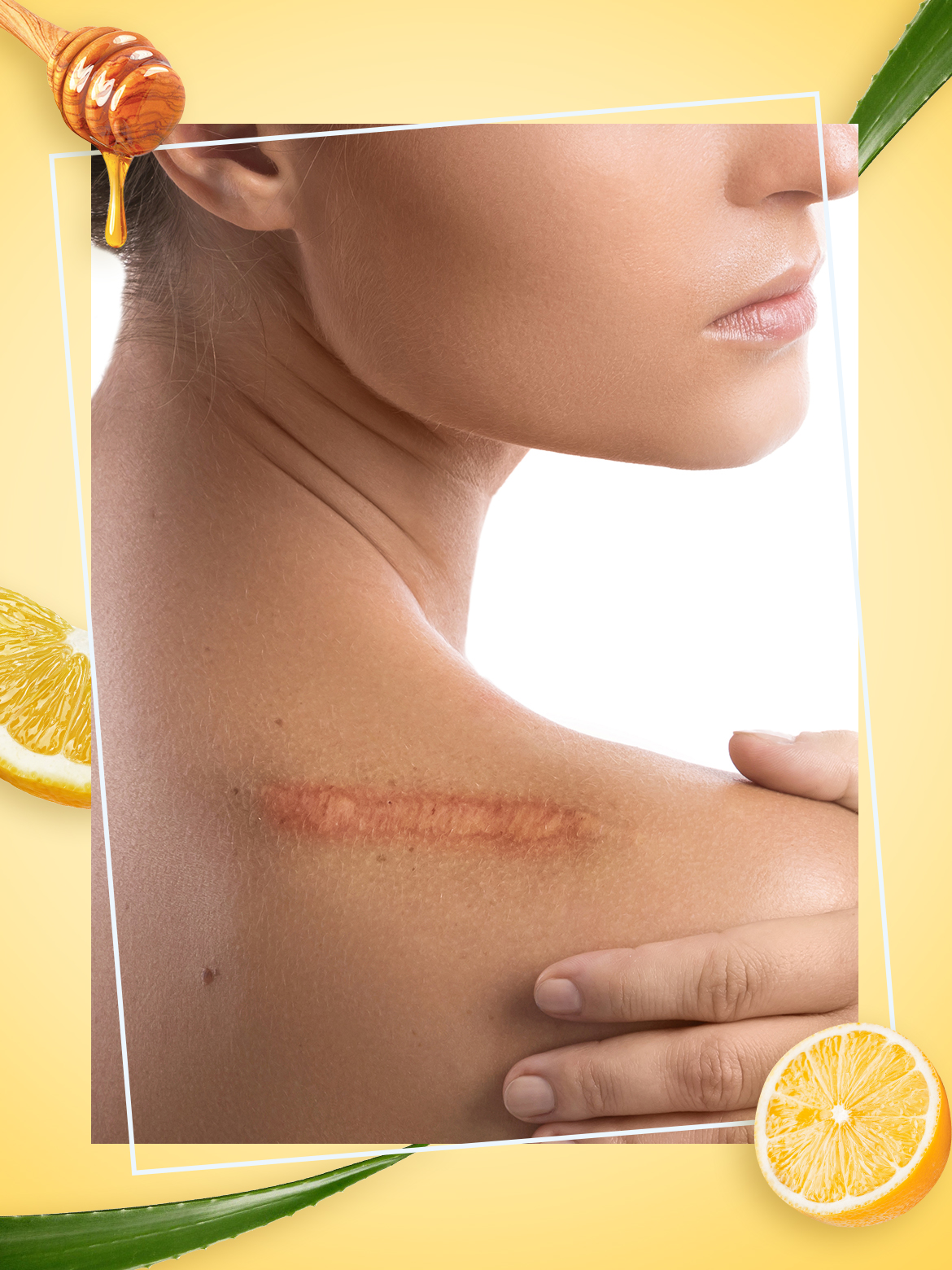 Easy Home Remedies You Can Try To Lighten Scars Naturally 5402